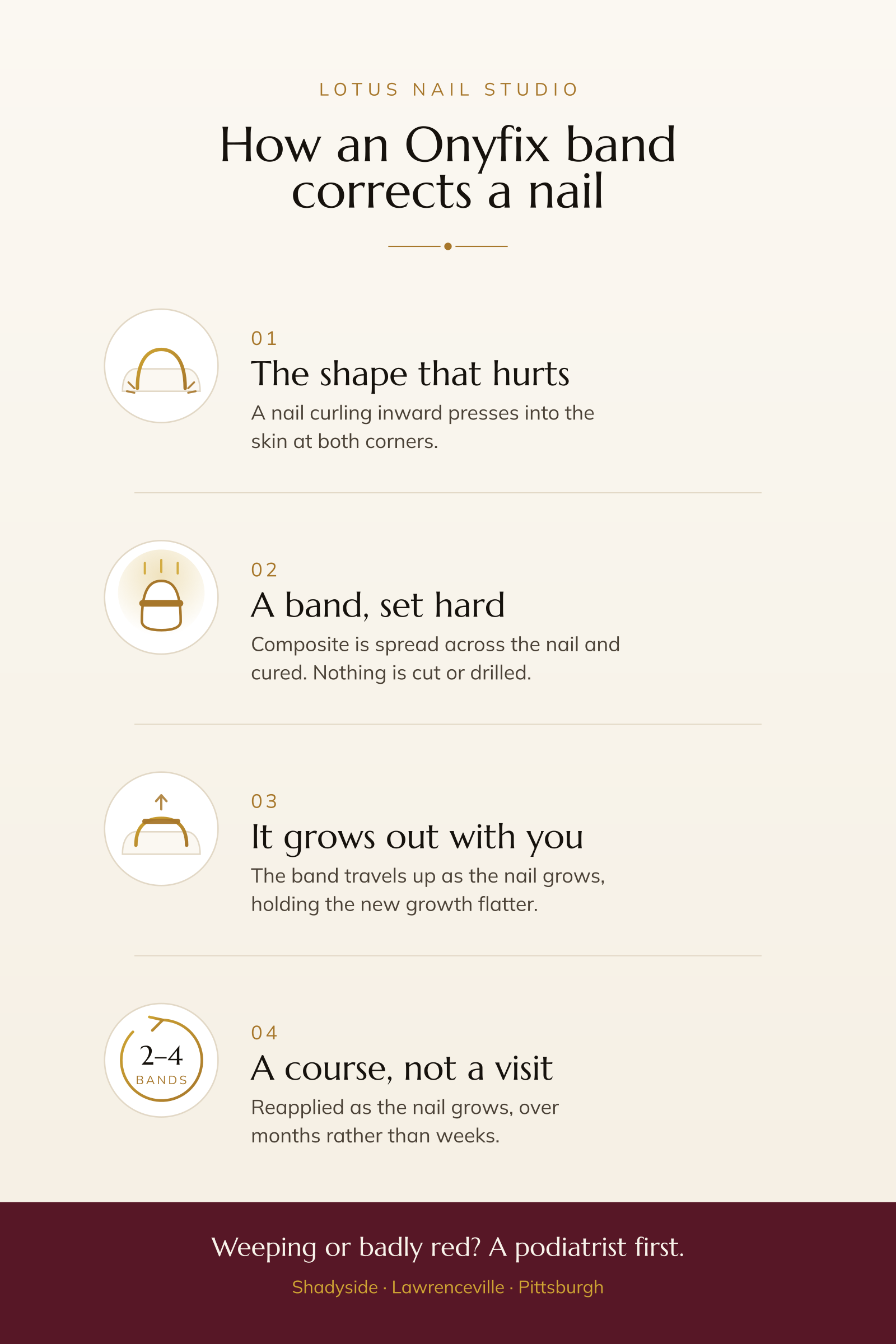 Four stages of Onyfix toenail correction: a nail curling into the skin at both corners, a composite band cured across the nail, the band travelling up as the nail grows out flatter, and a course of two to four bands over months.
